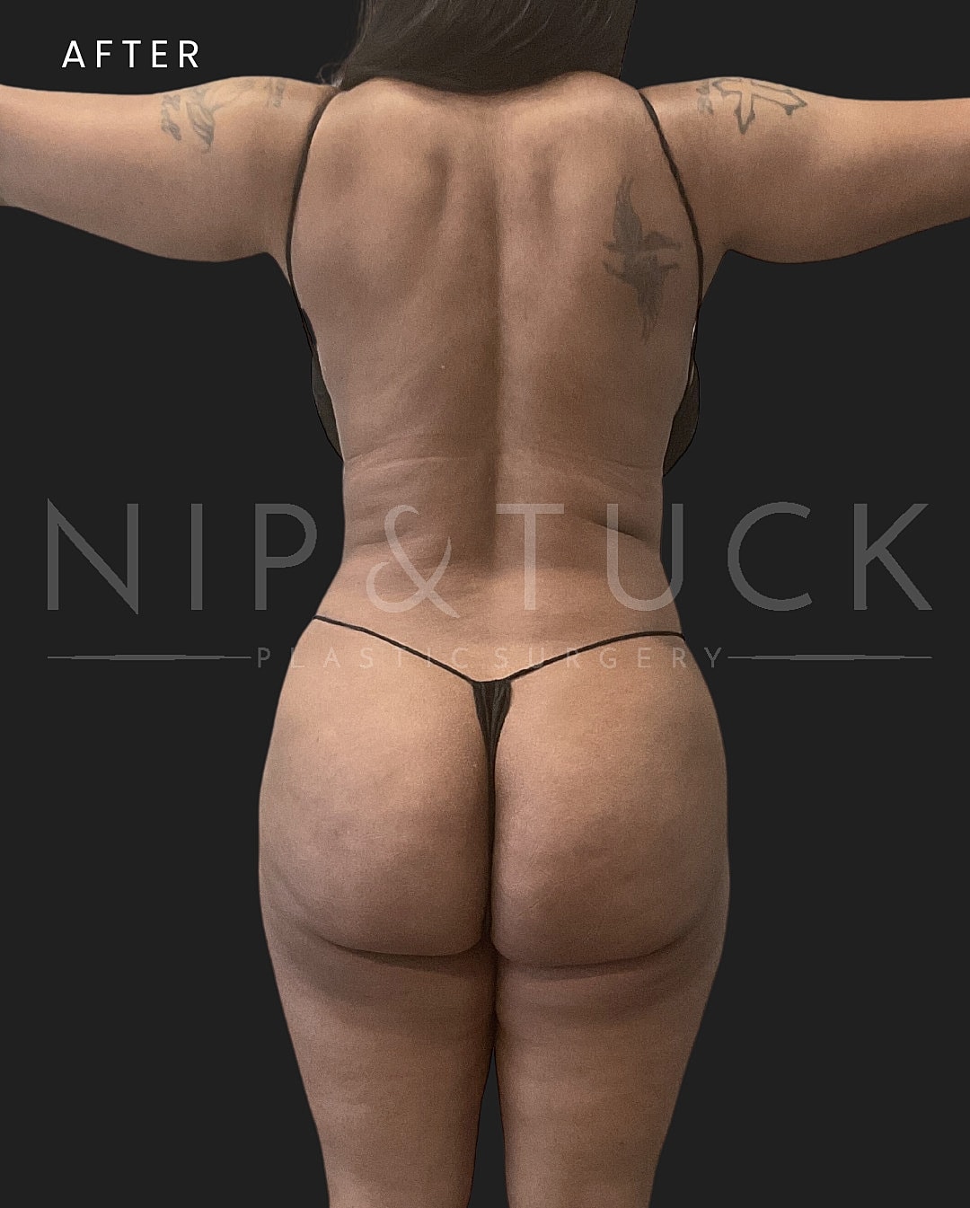 Vaser Liposuction Before & After