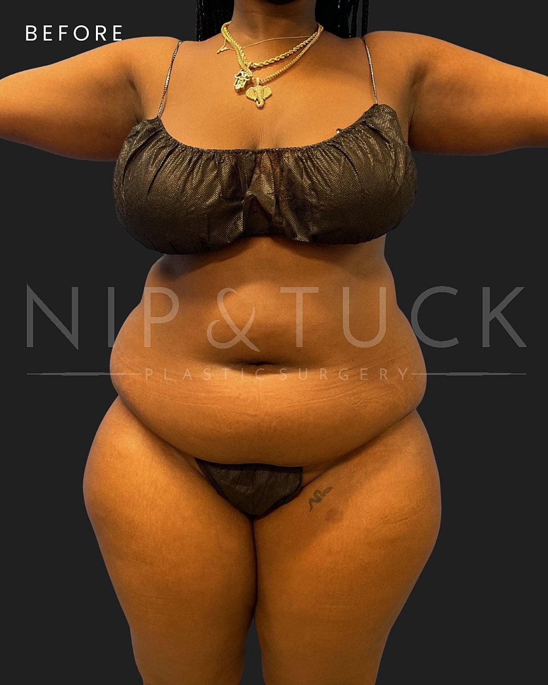 Vaser Liposuction Before & After