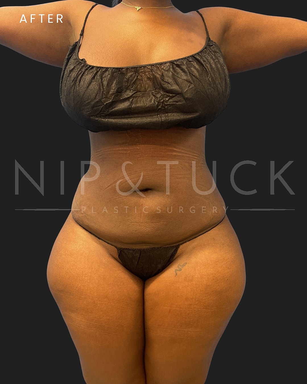 Vaser Liposuction Before & After