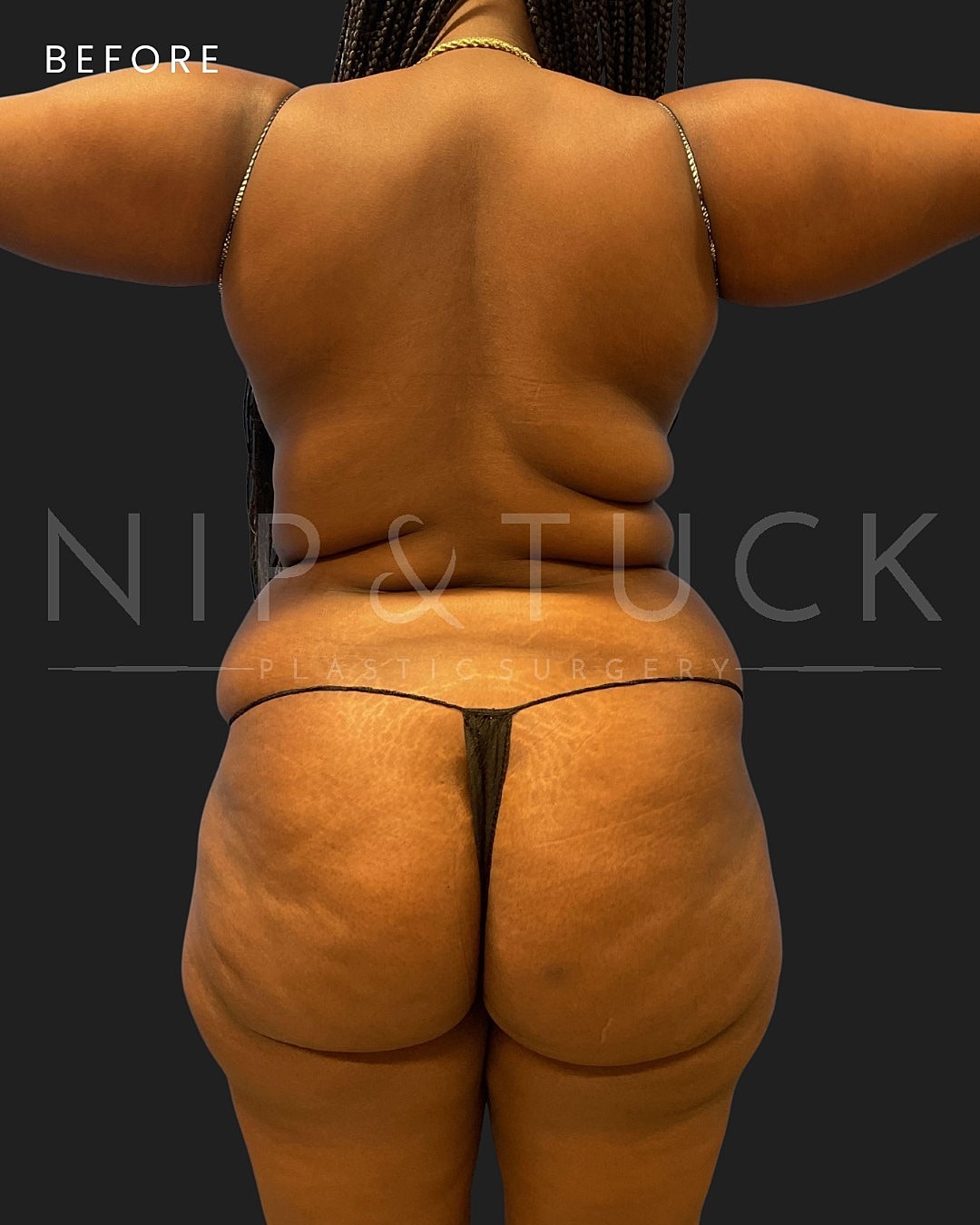 Vaser Liposuction Before & After