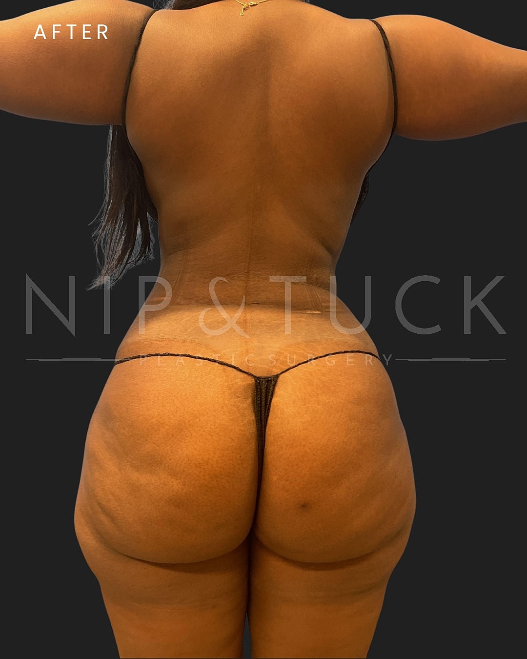 Vaser Liposuction Before & After