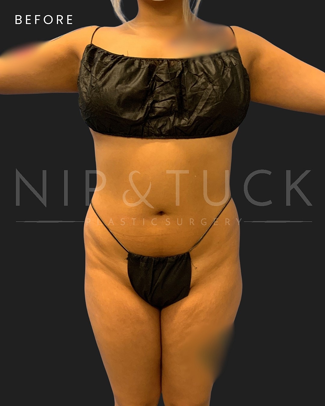 Vaser Liposuction Before & After