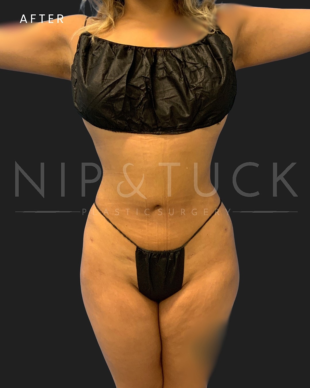 Vaser Liposuction Before & After