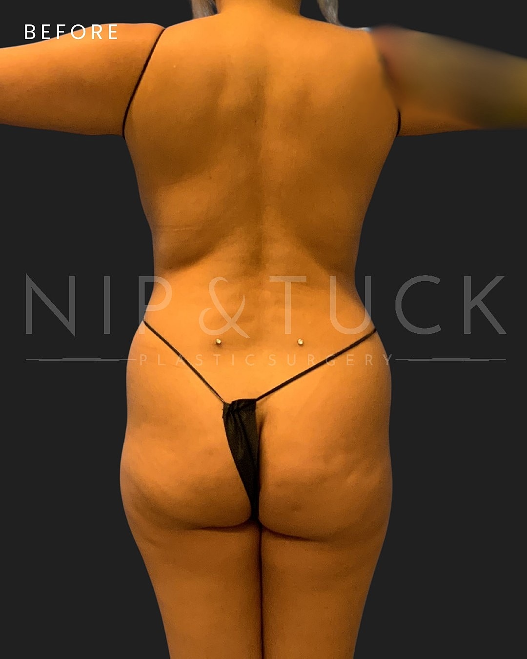 Vaser Liposuction Before & After