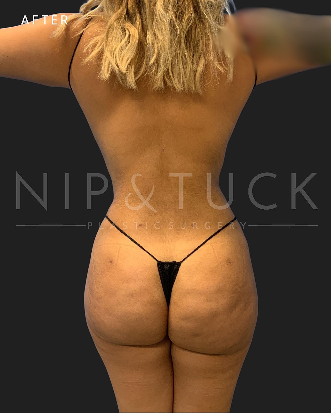 Vaser Liposuction Before & After