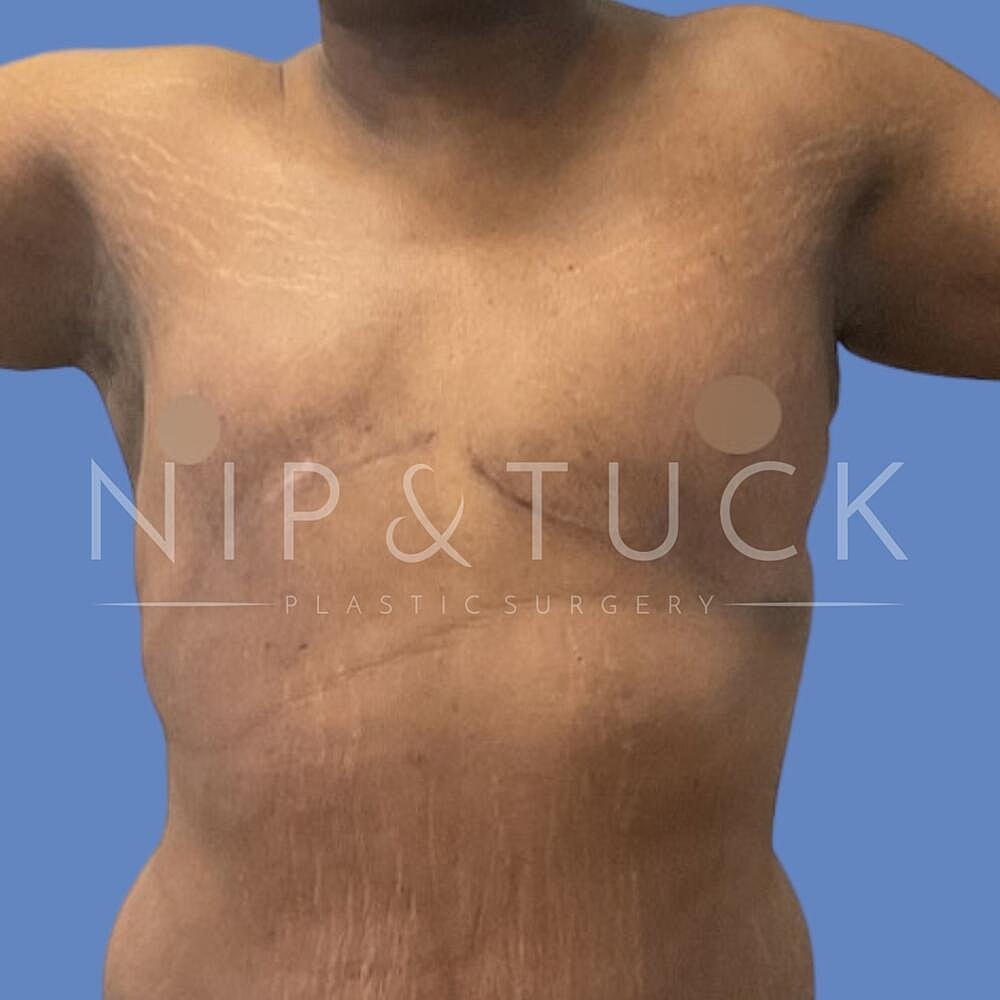 Gynecomastia Before & After