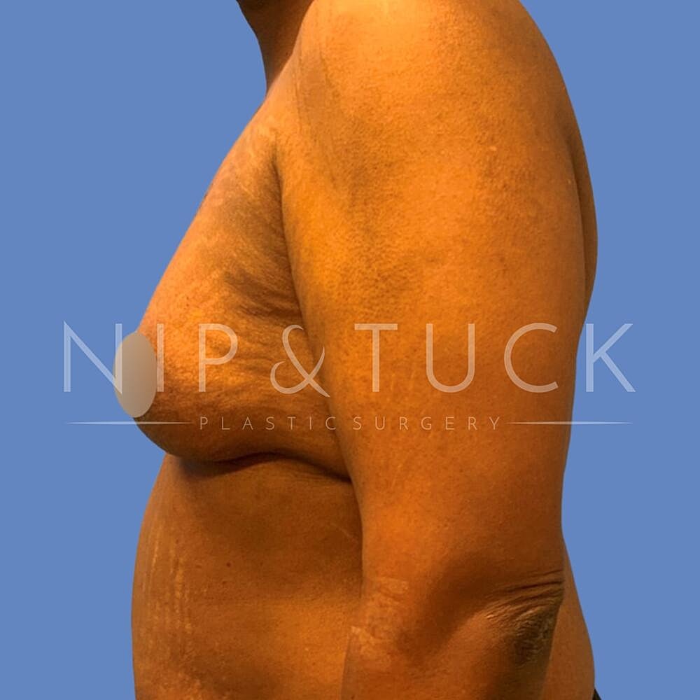 Gynecomastia Before & After