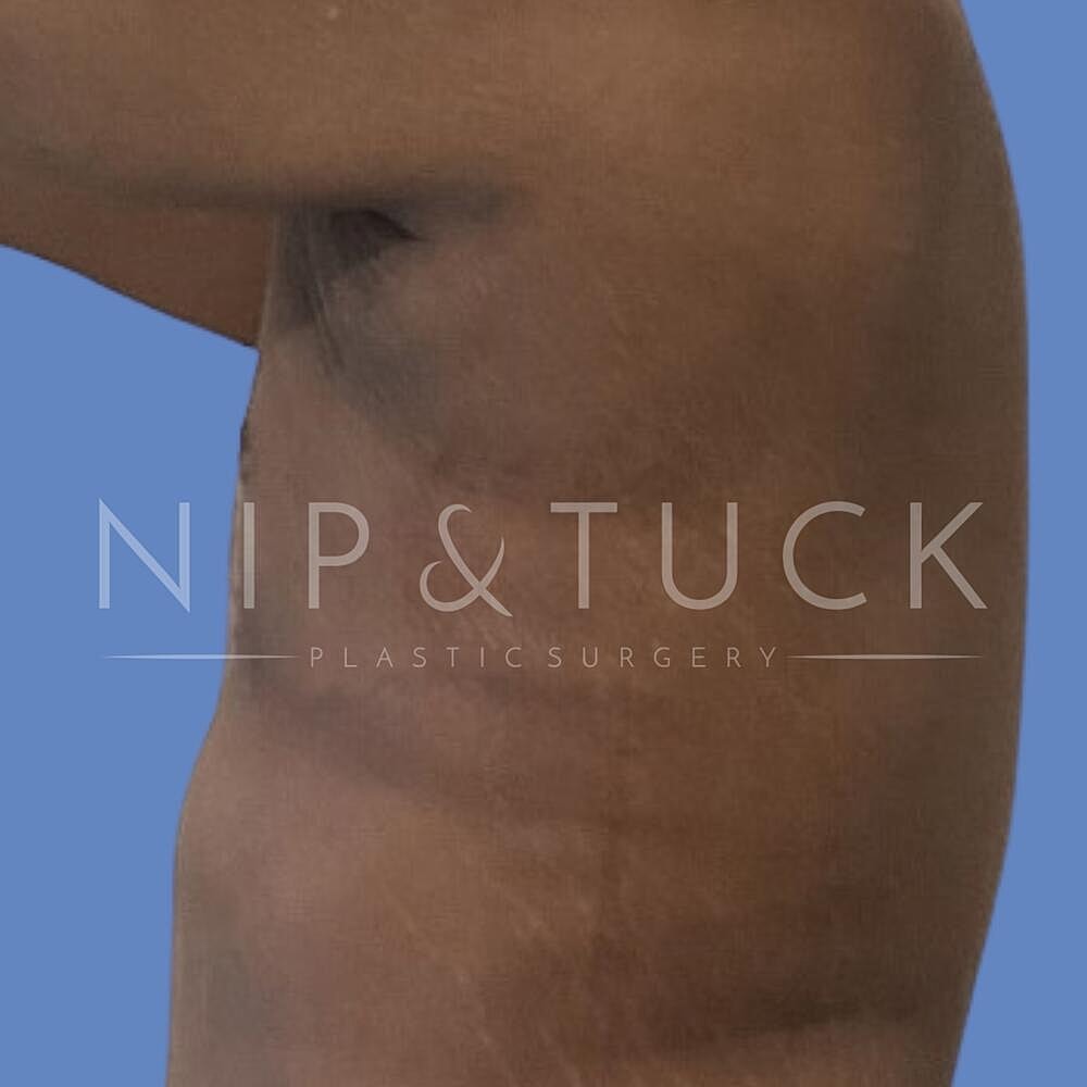 Gynecomastia Before & After