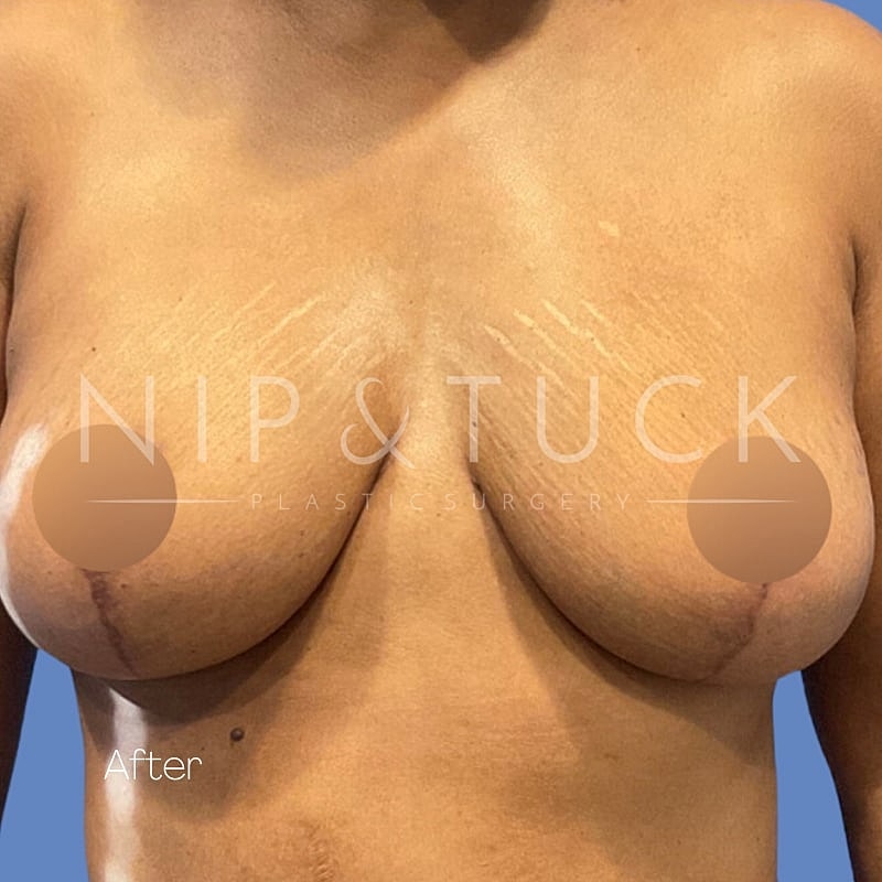 Breast Lift Before & After