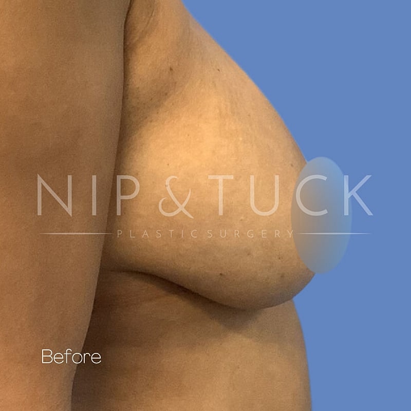Breast Lift Before & After