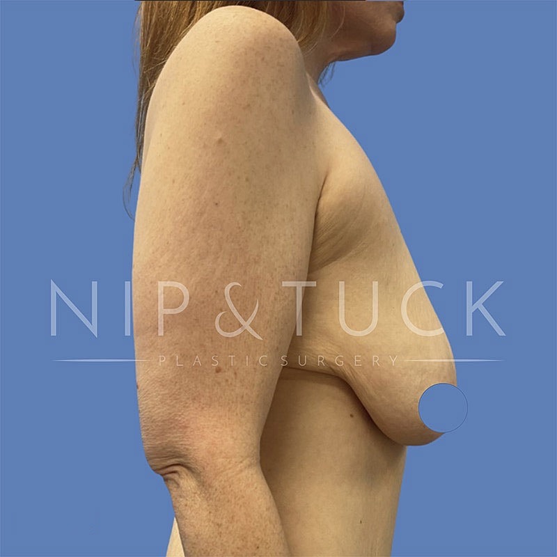 Breast Lift Before & After