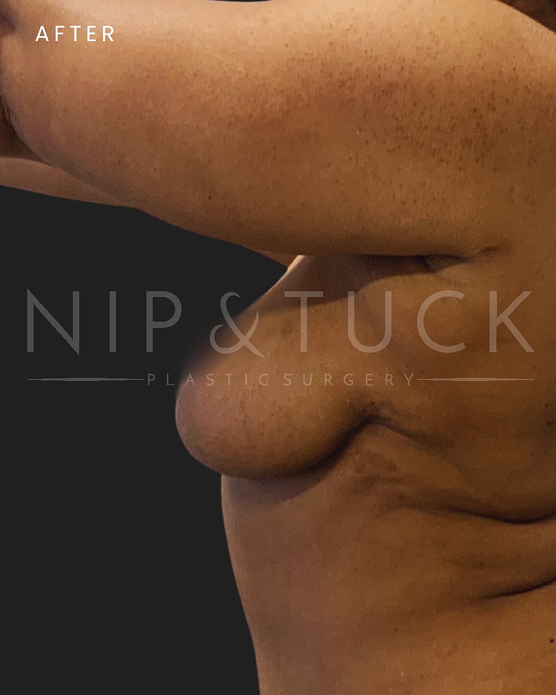 Breast Lift Before & After
