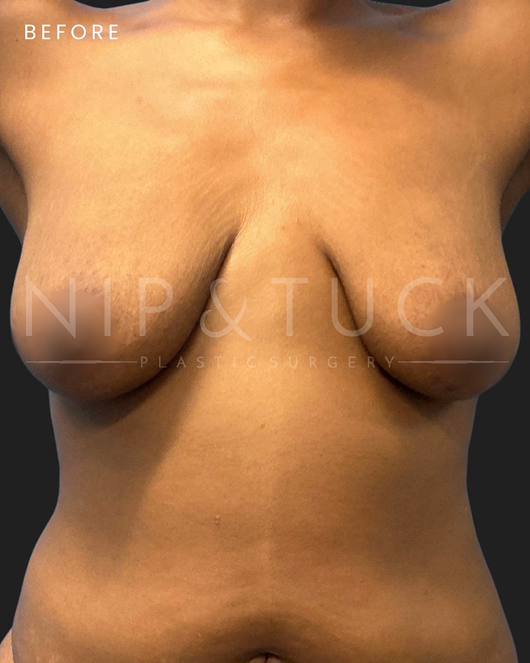 Breast Lift Before & After