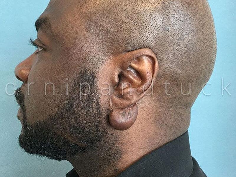 Keloid Excision Before & After