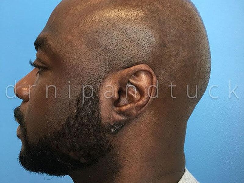 Keloid Excision Before & After