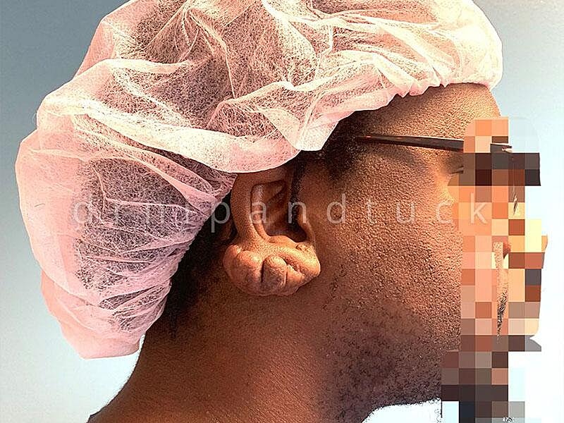 Keloid Excision Before & After