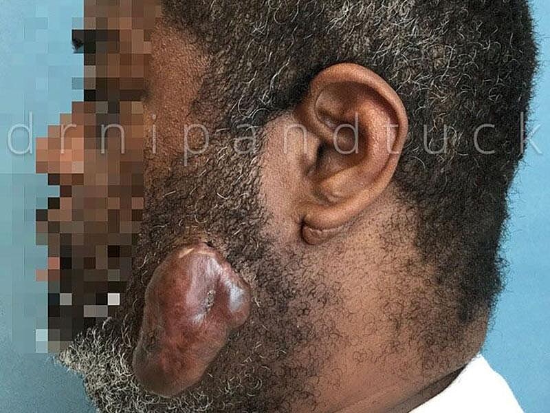 Keloid Excision Before & After