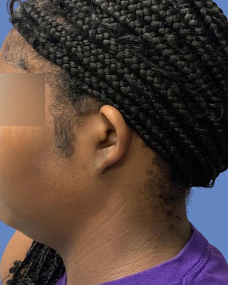 Keloid Excision Before & After