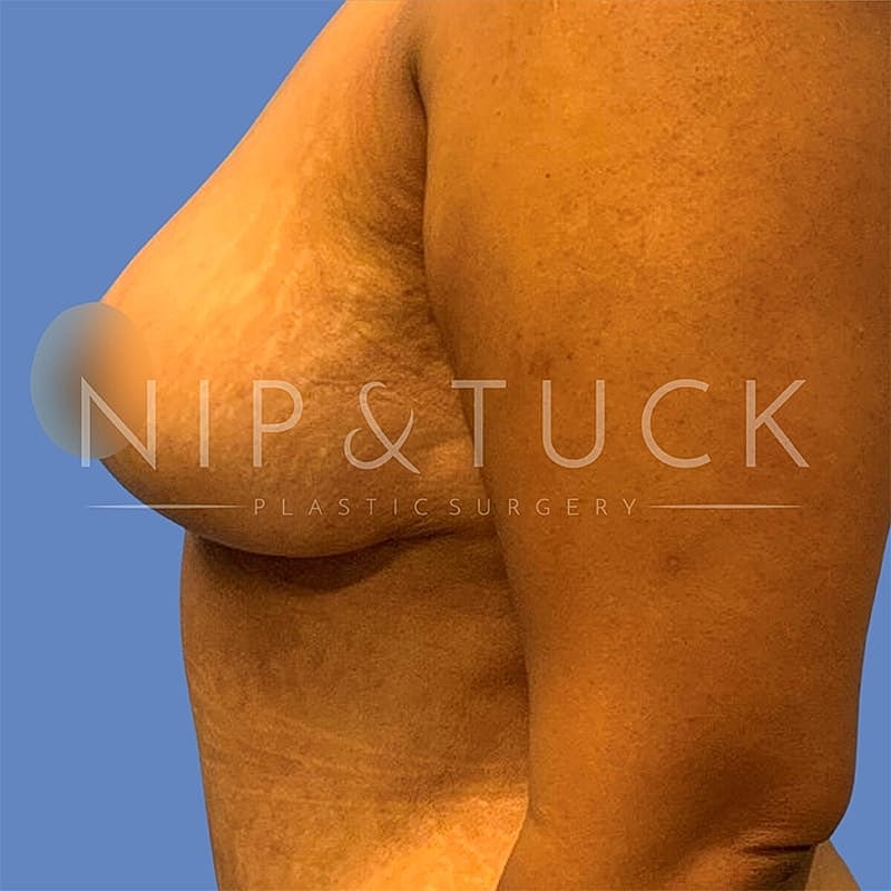 Breast Reduction Before & After