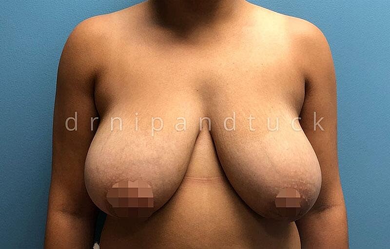 Breast Reduction Before & After
