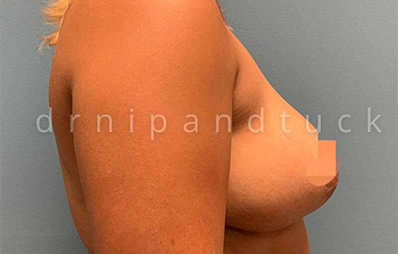 Breast Reduction Before & After