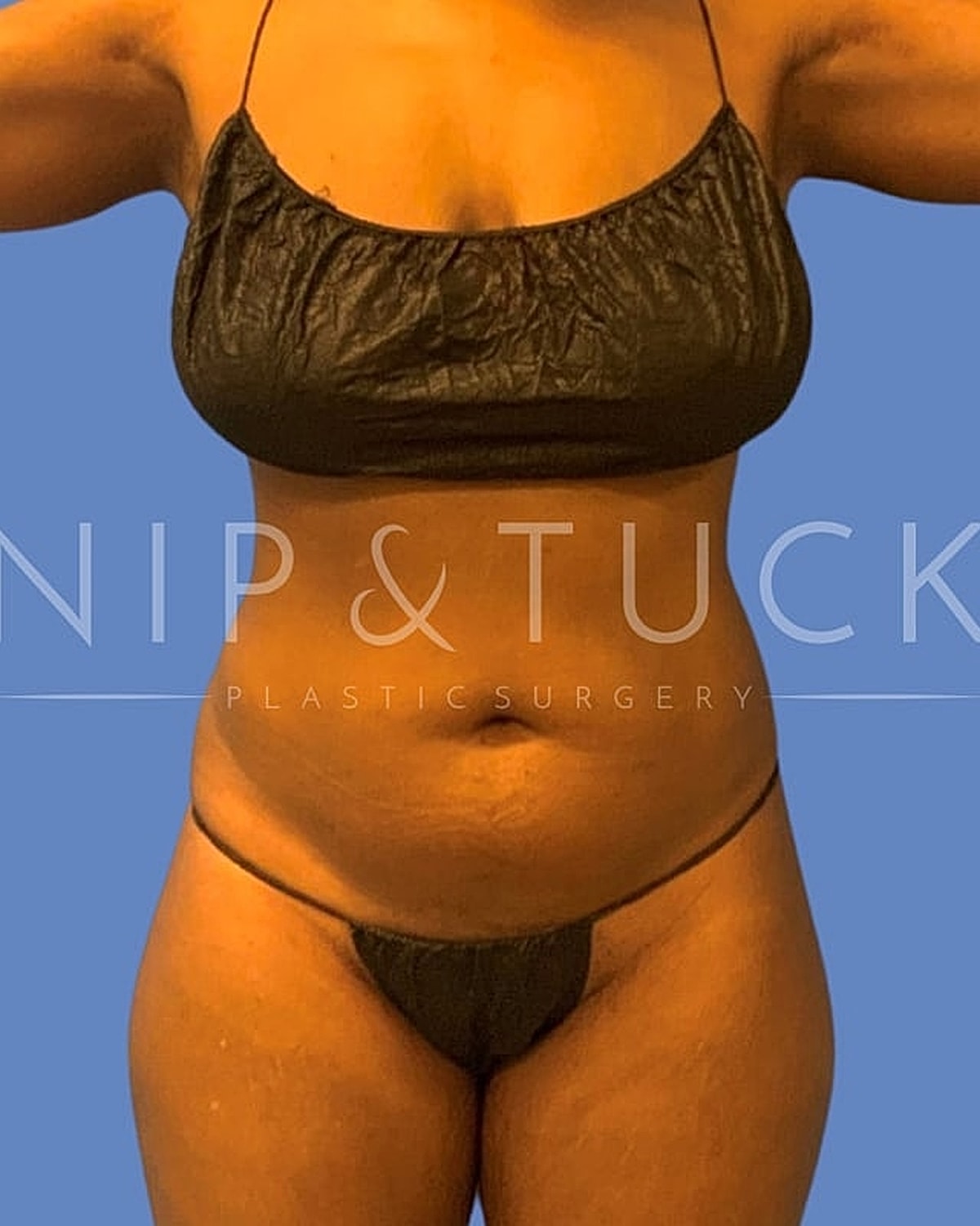 Brazilian Butt Lift Before & After