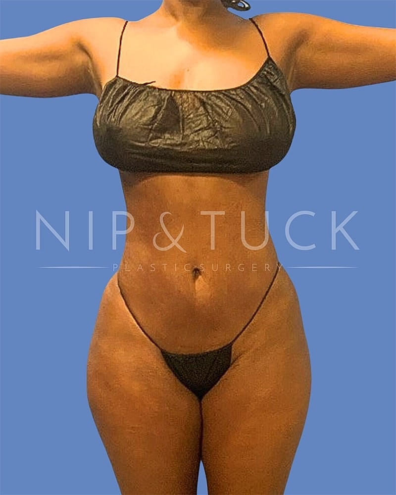 Brazilian Butt Lift Before & After