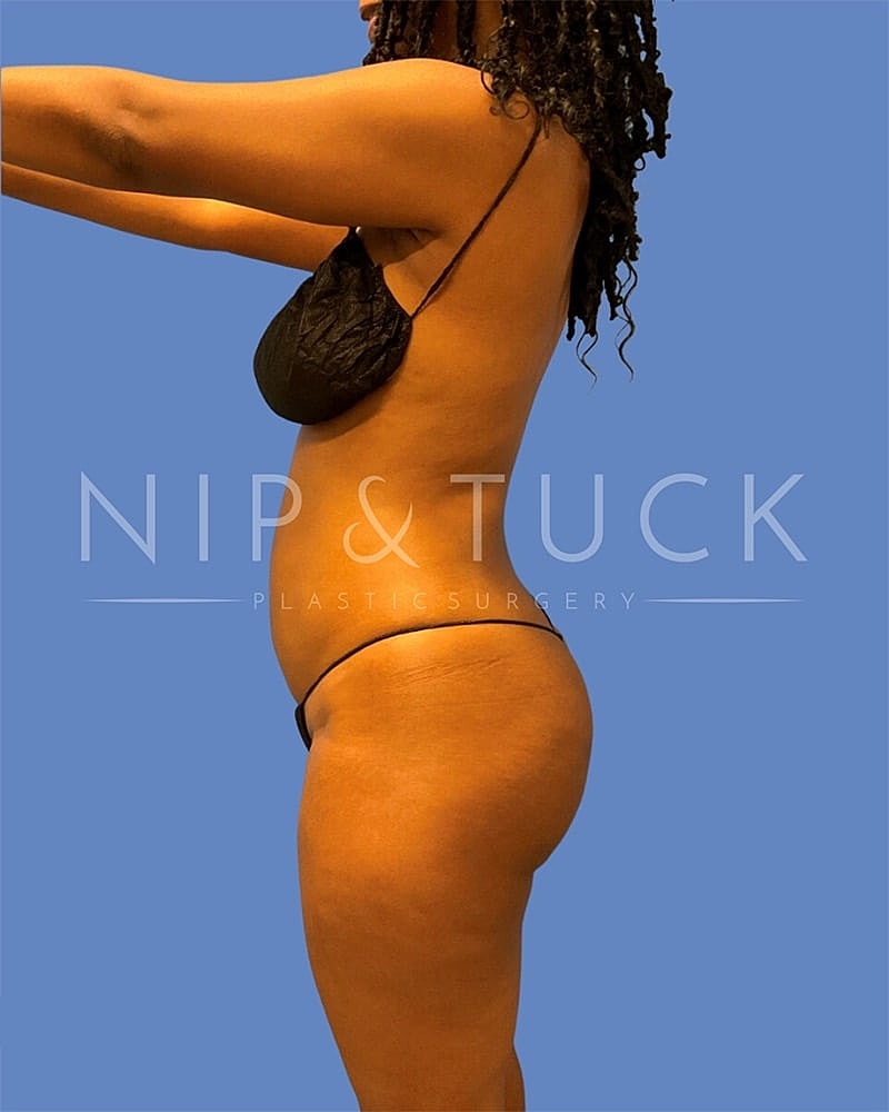 Brazilian Butt Lift Before & After