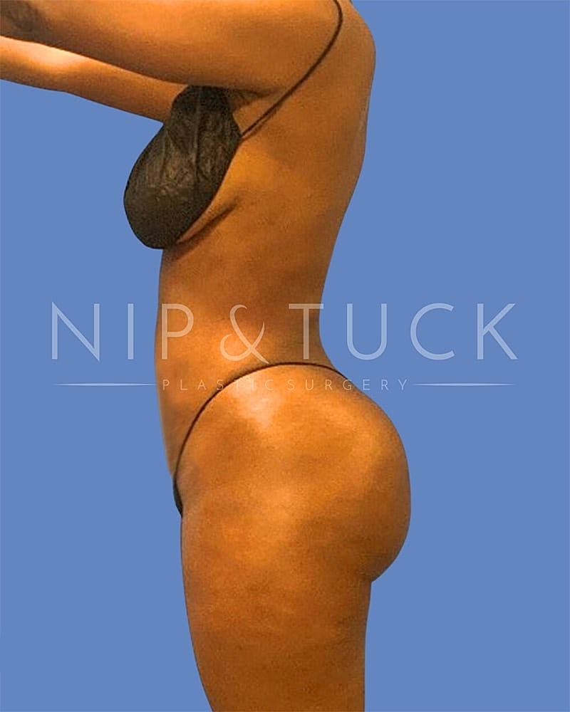 Brazilian Butt Lift Before & After