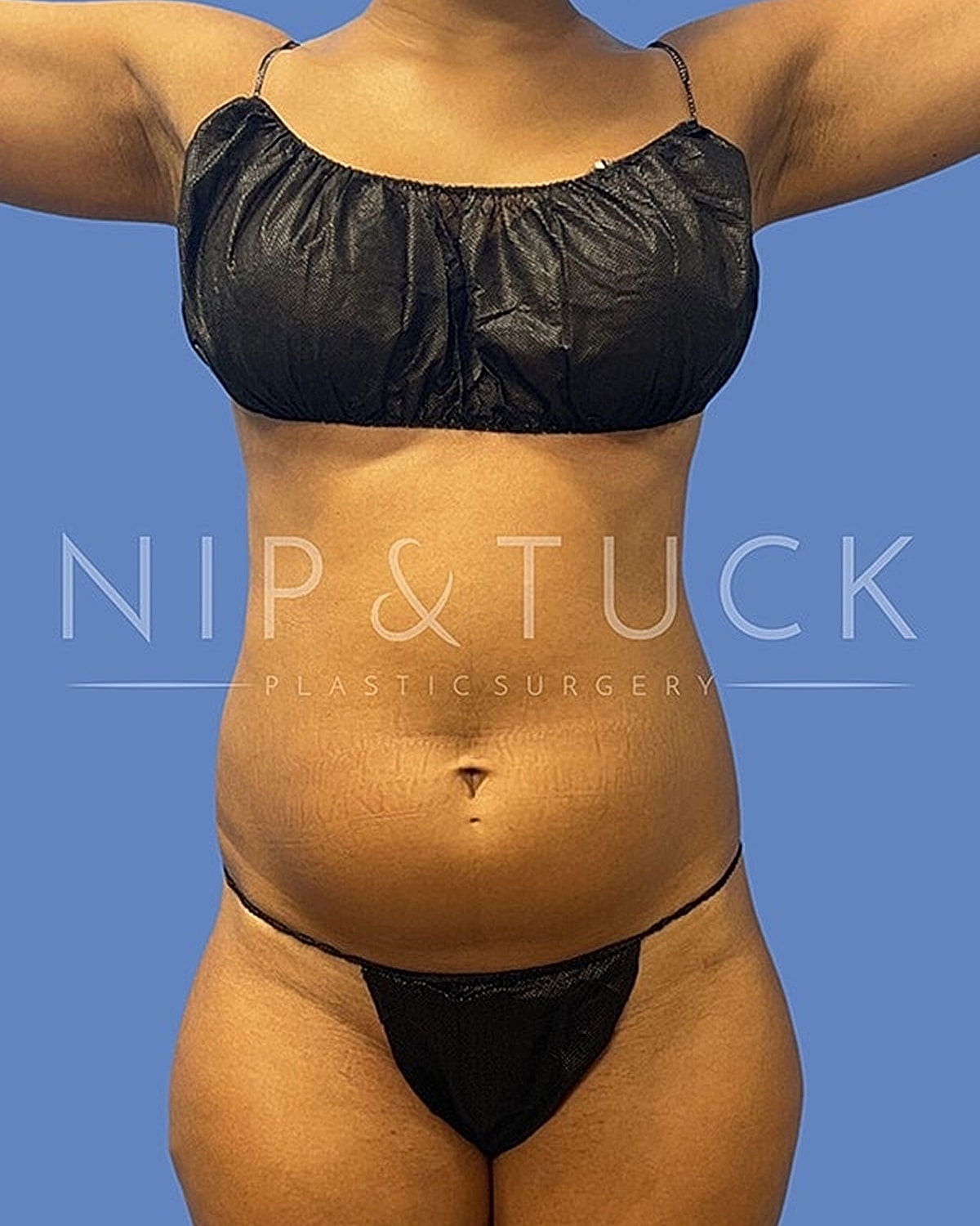 Brazilian Butt Lift Before & After