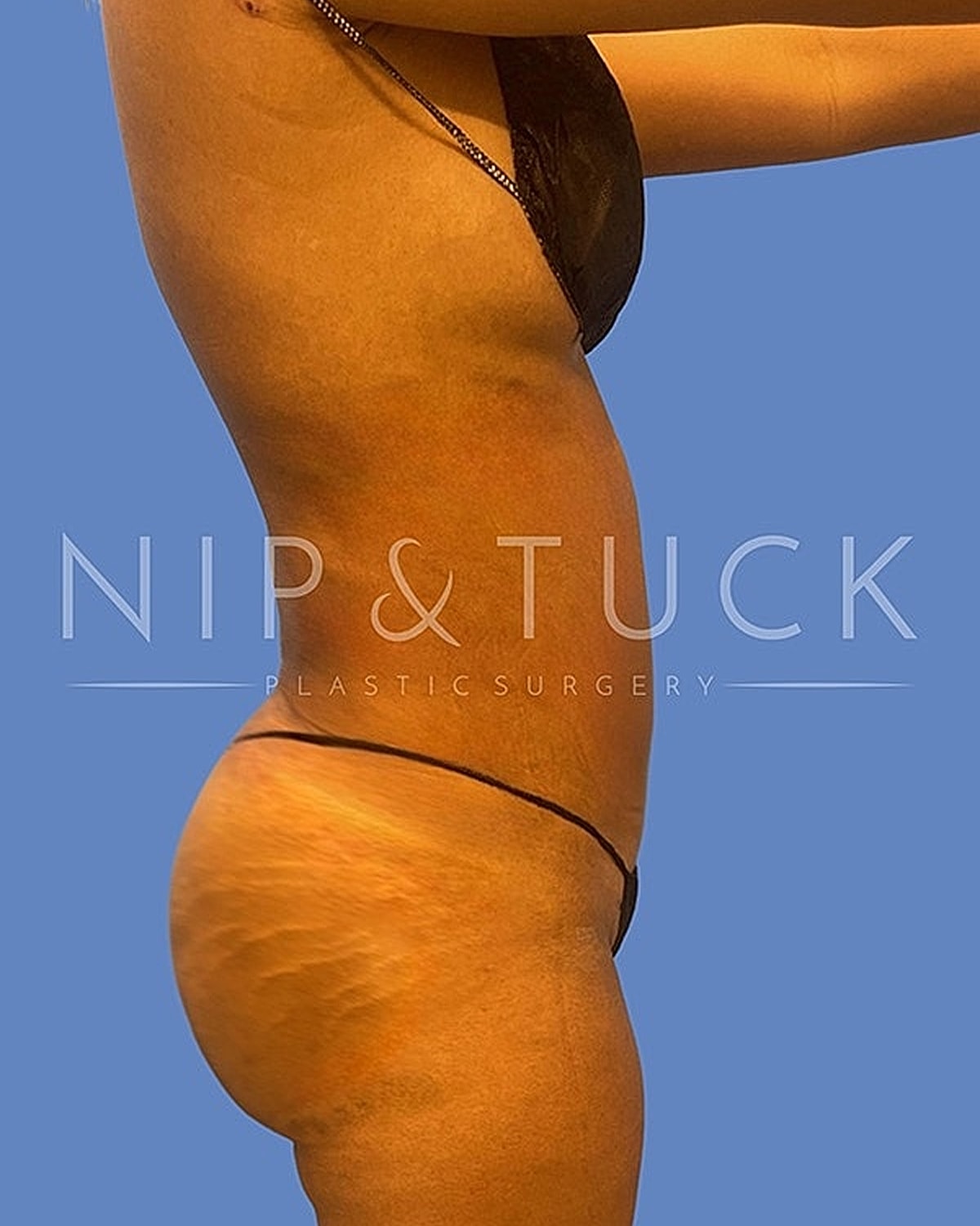 Brazilian Butt Lift Before & After