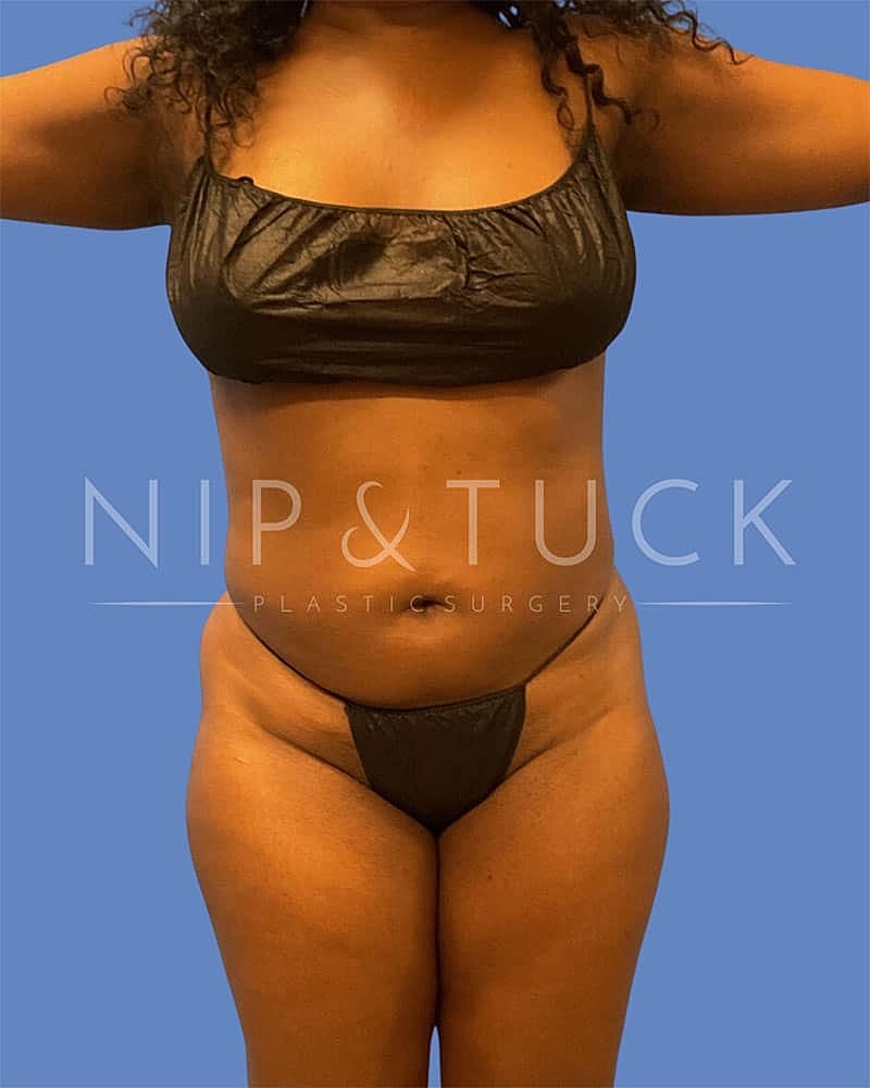 Brazilian Butt Lift Before & After