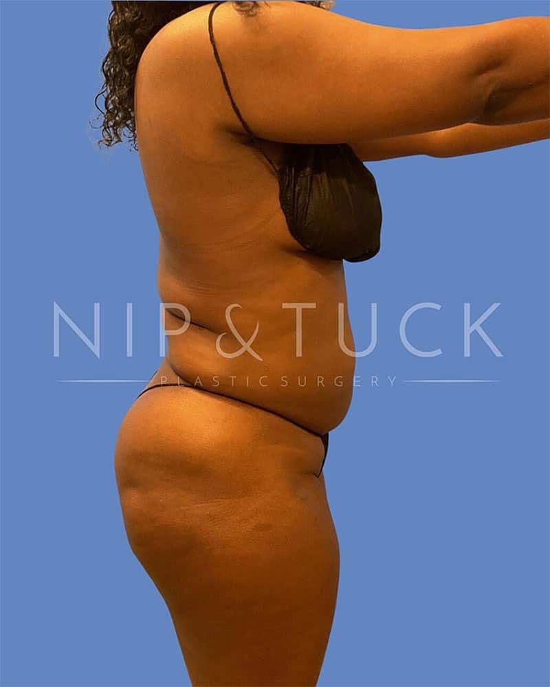 Brazilian Butt Lift Before & After