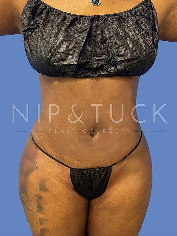 Brazilian Butt Lift Before & After