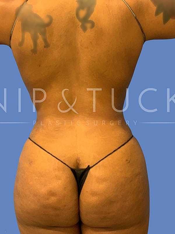 Brazilian Butt Lift Before & After