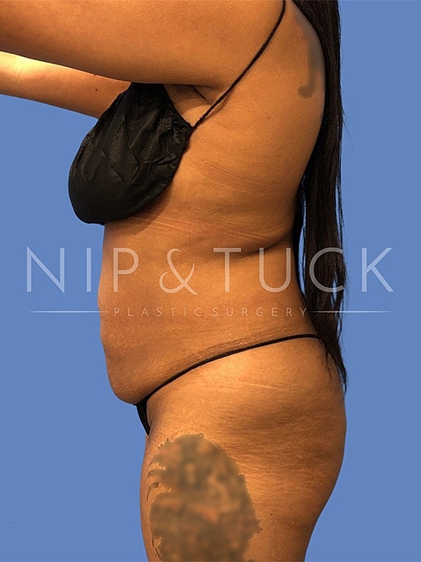 Brazilian Butt Lift Before & After