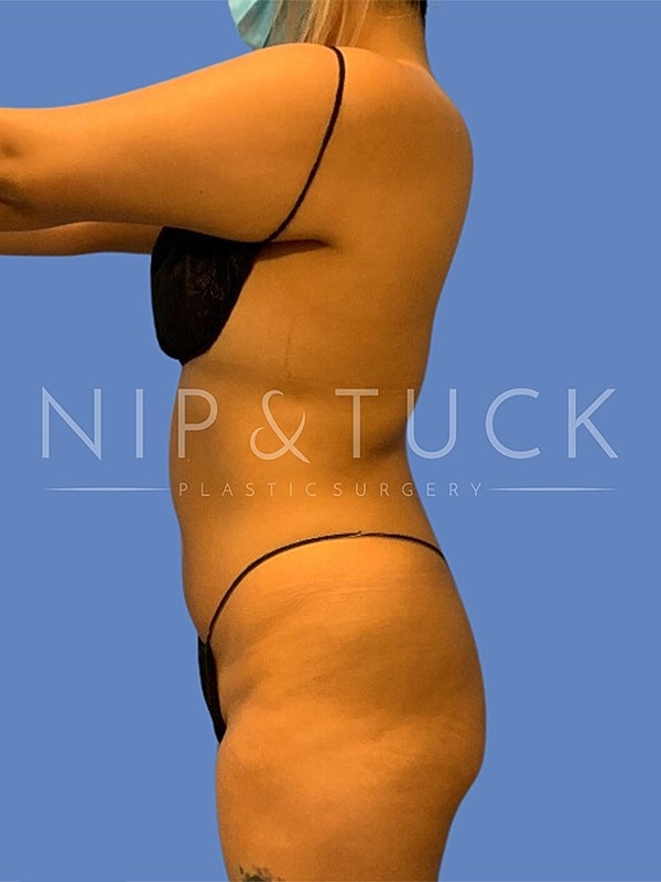 Brazilian Butt Lift Before & After