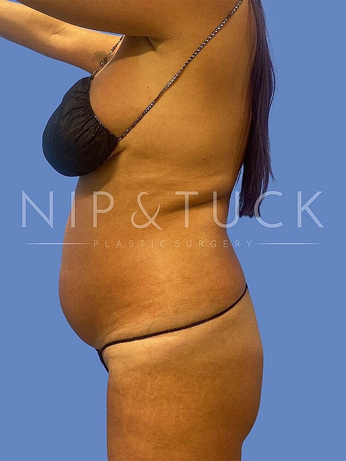 Brazilian Butt Lift Before & After