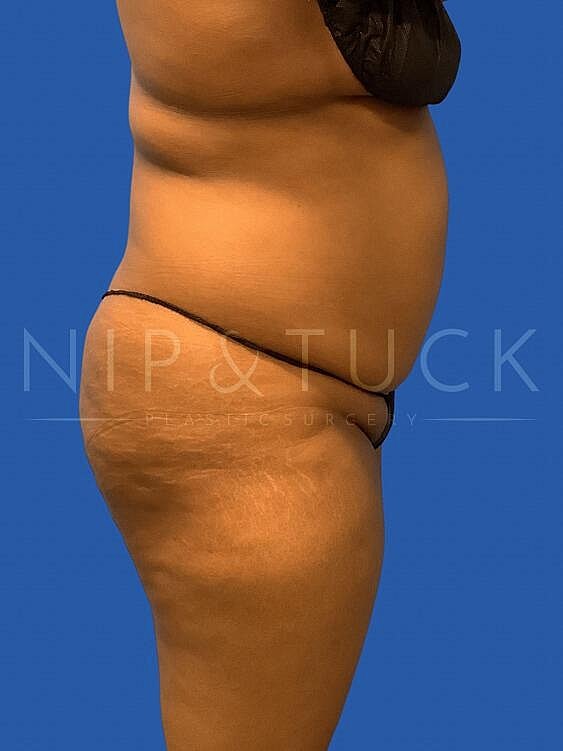 Brazilian Butt Lift Before & After