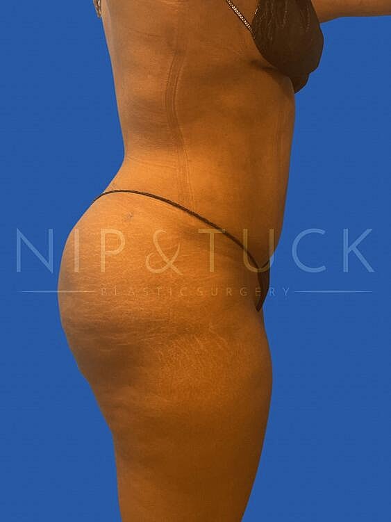 Brazilian Butt Lift Before & After