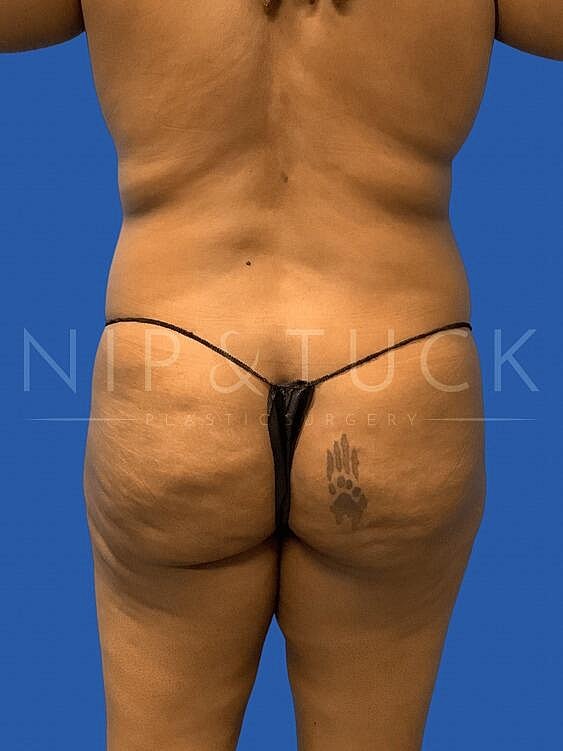 Brazilian Butt Lift Before & After