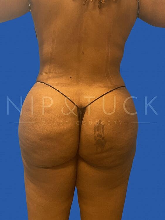 Brazilian Butt Lift Before & After