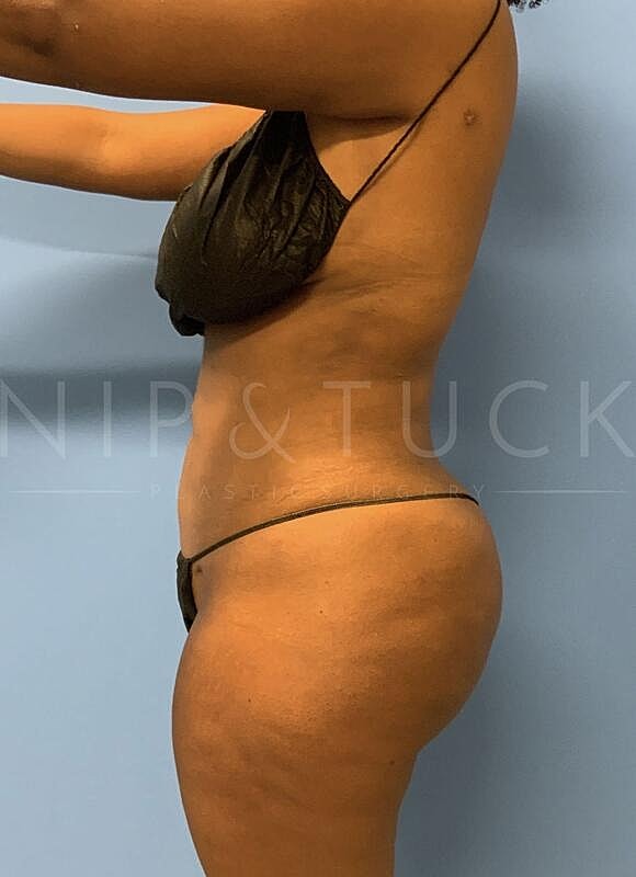 Brazilian Butt Lift Before & After