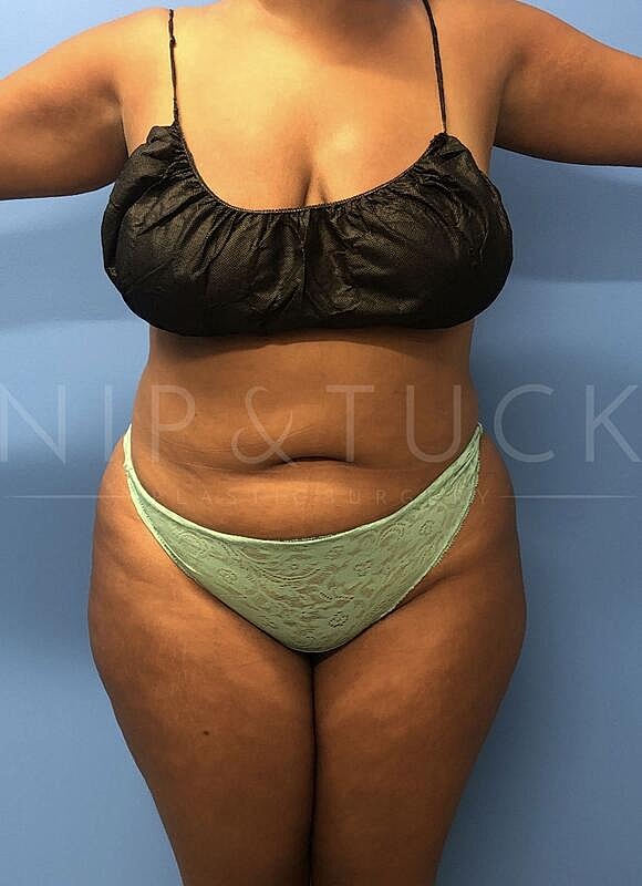 Brazilian Butt Lift Before & After