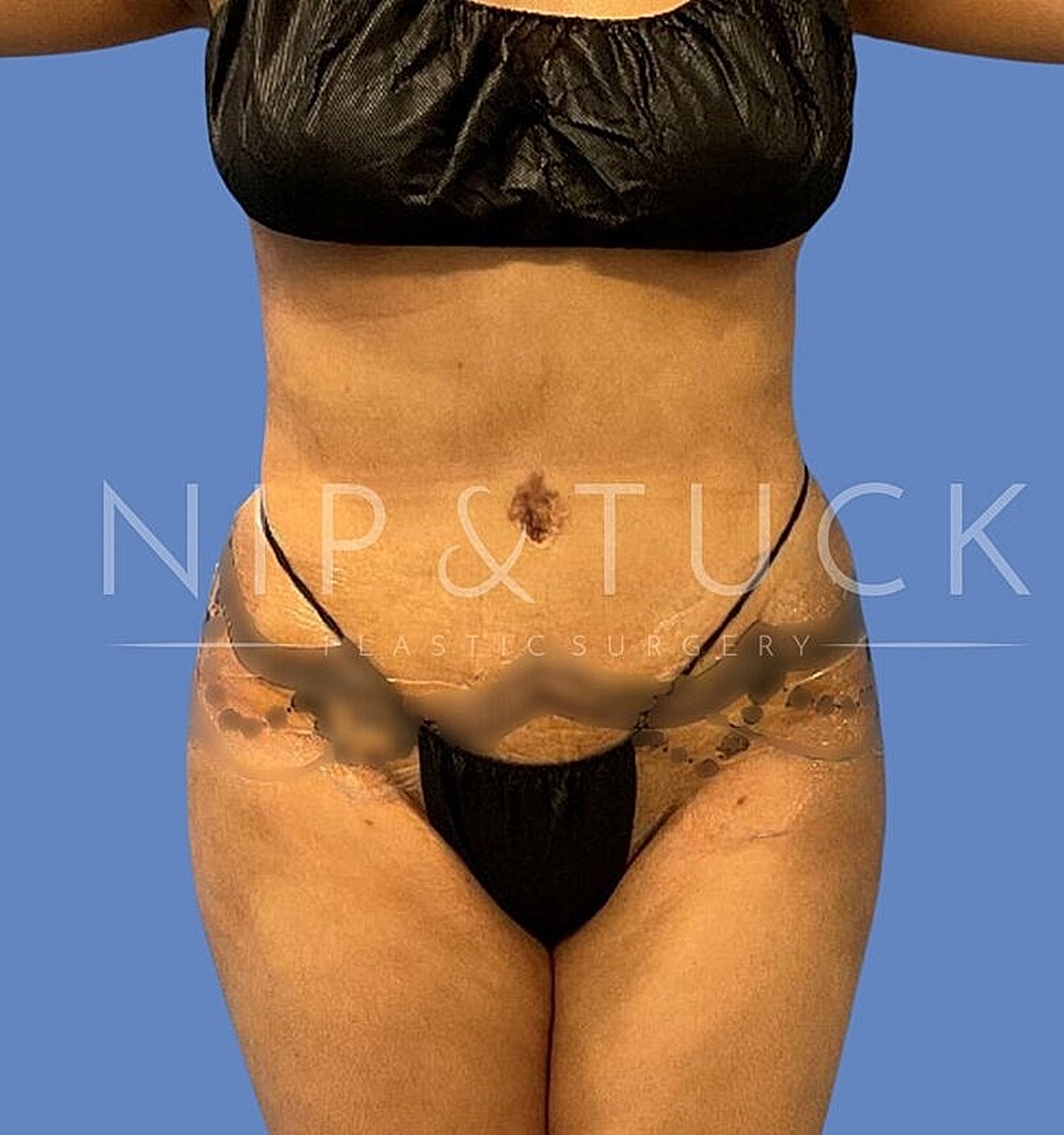 Brazilian Butt Lift Before & After