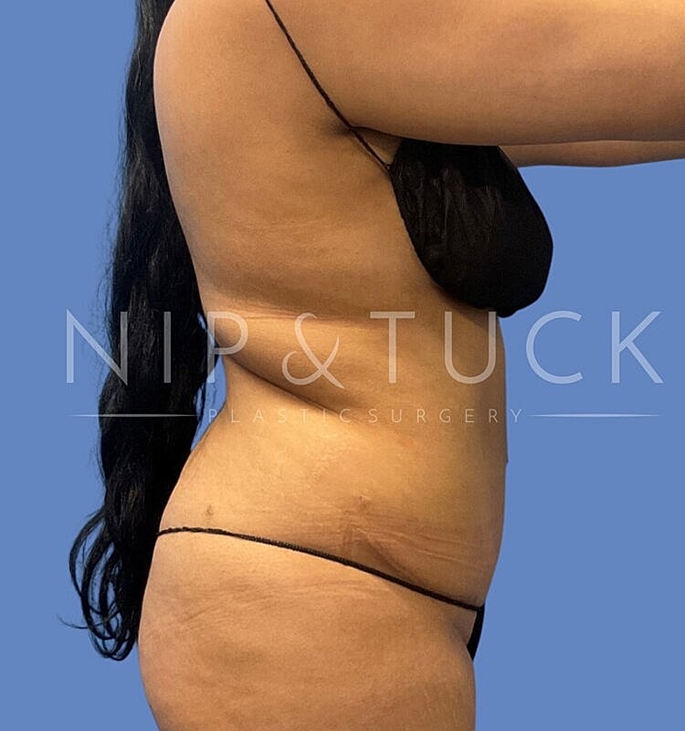 Brazilian Butt Lift Before & After