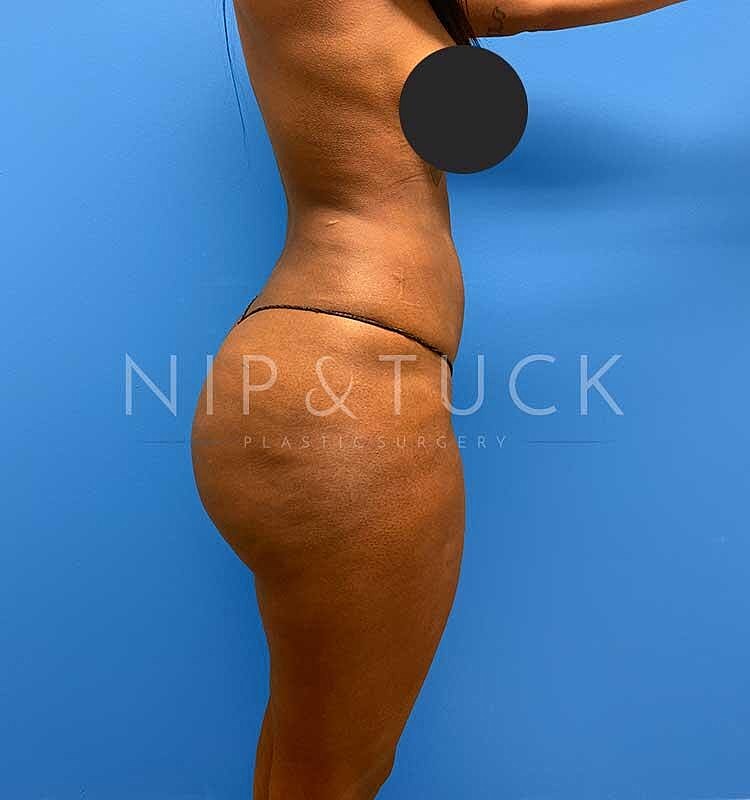 Brazilian Butt Lift Before & After