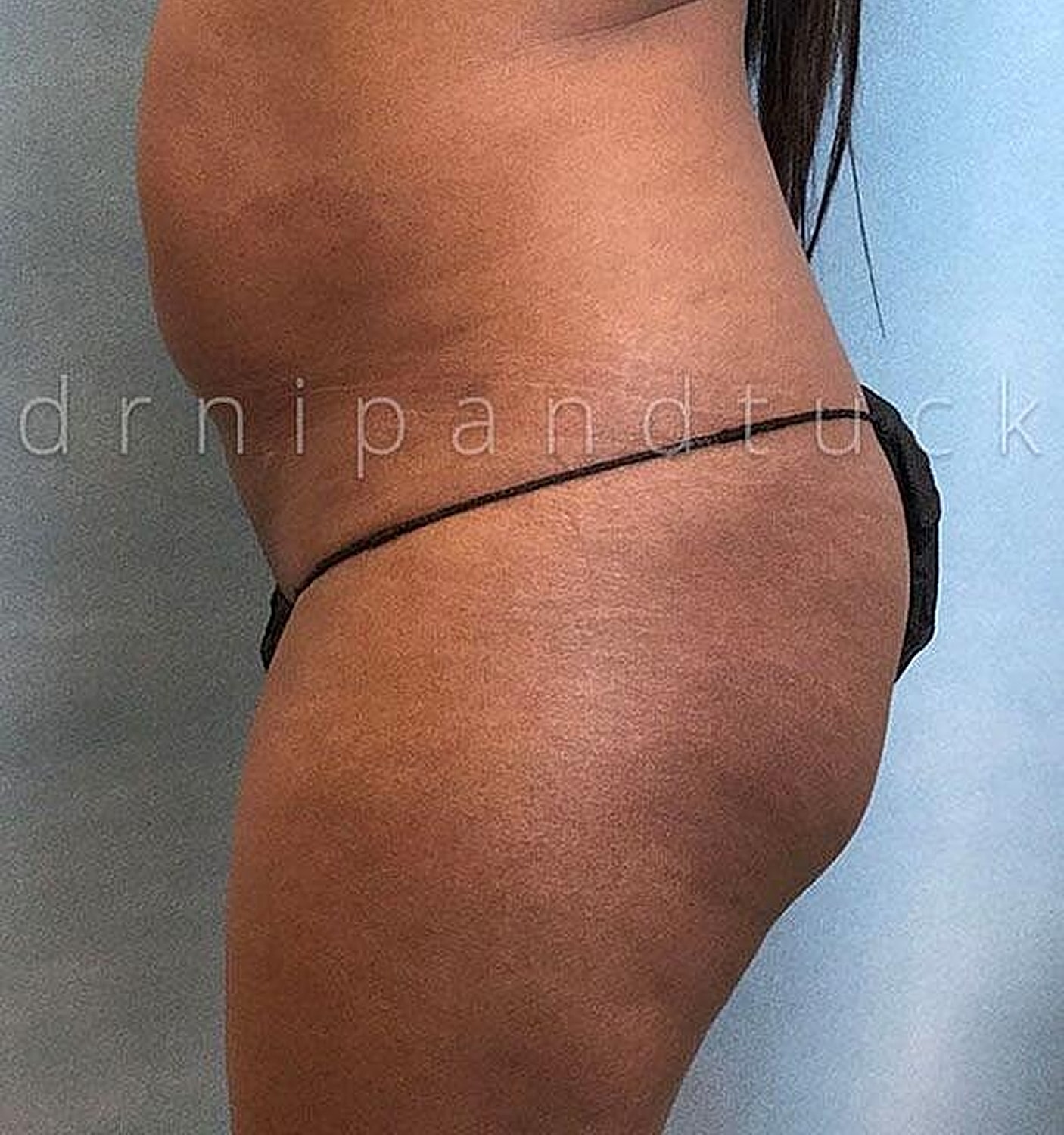 Brazilian Butt Lift Before & After