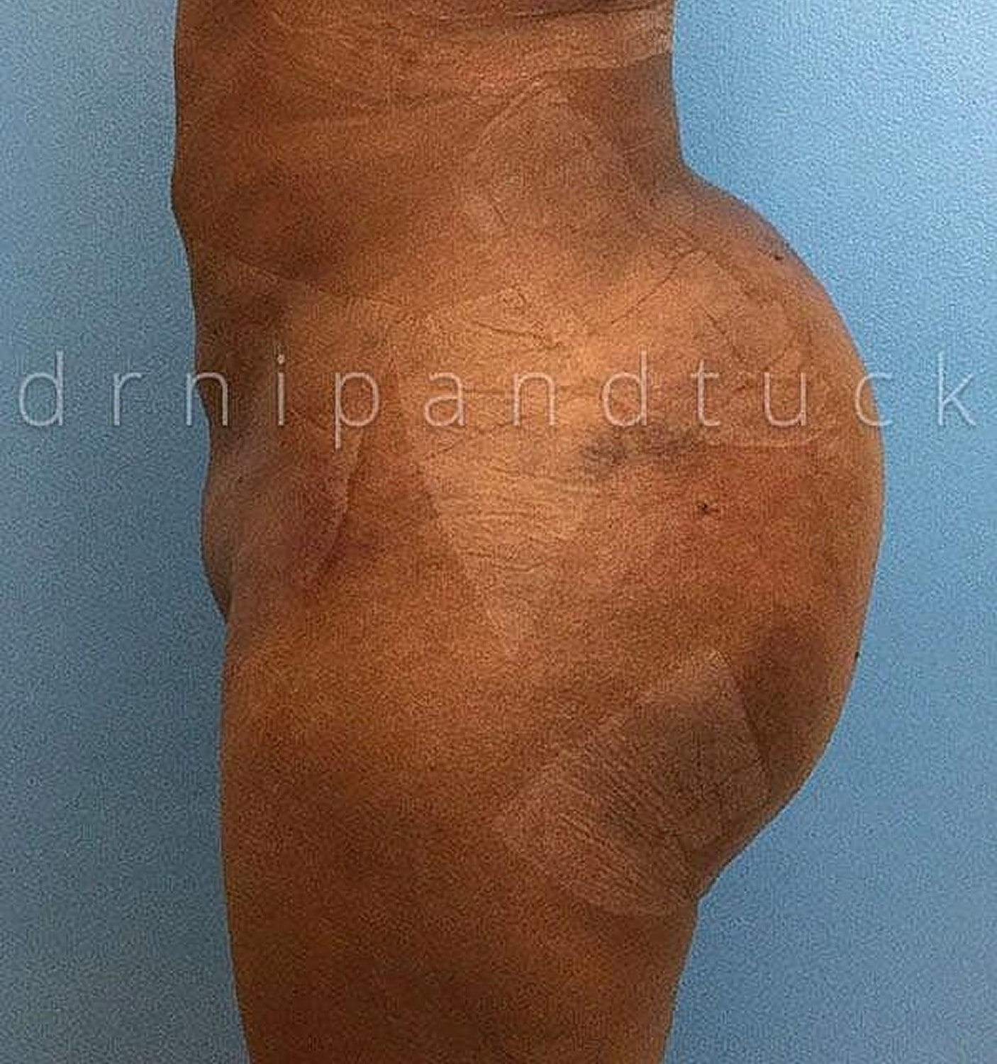 Brazilian Butt Lift Before & After