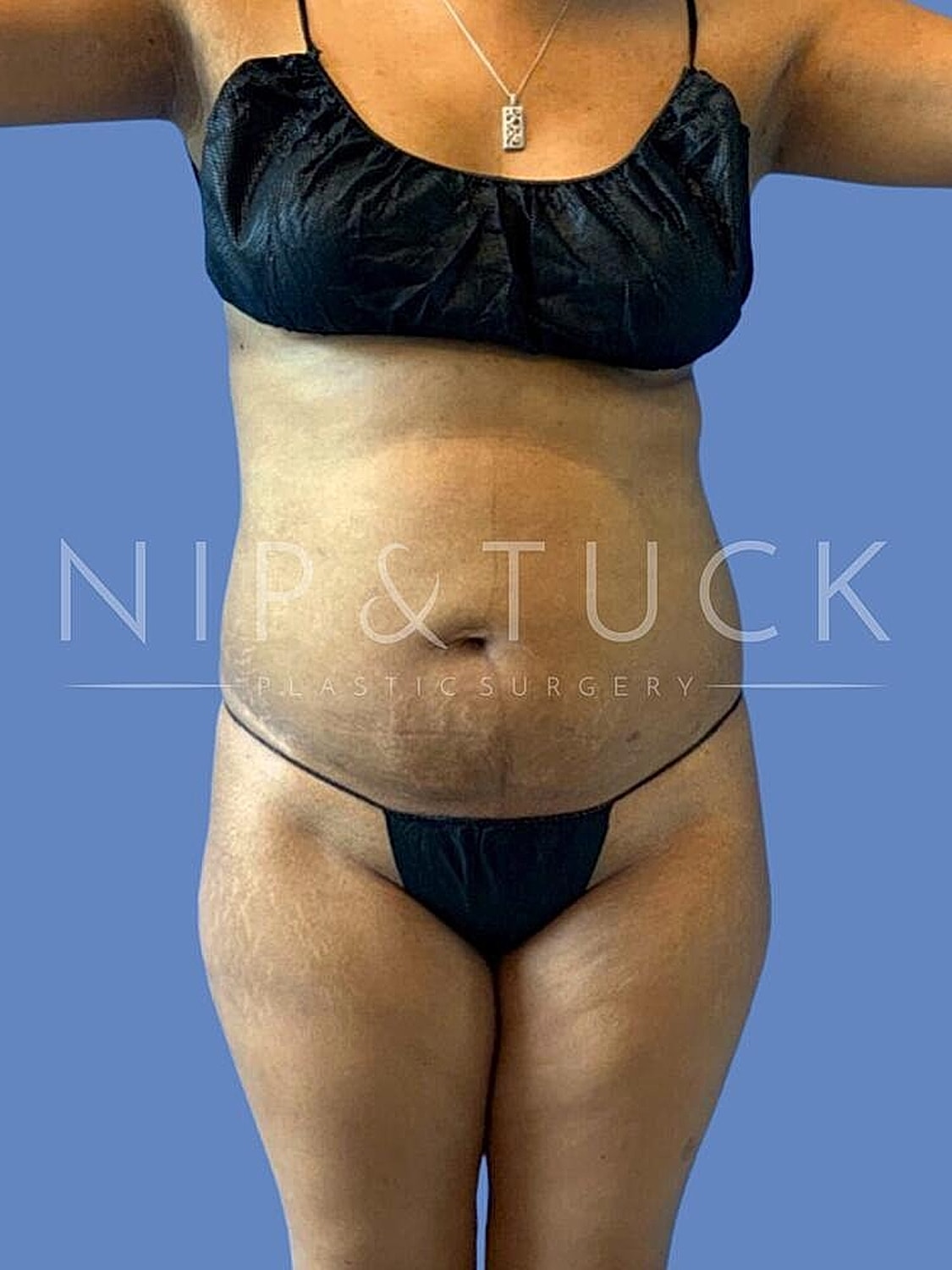 Brazilian Butt Lift Before & After